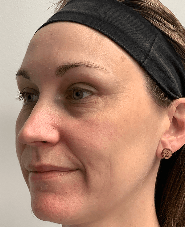 Halo Laser After - Patient 93894513 - Front Left View