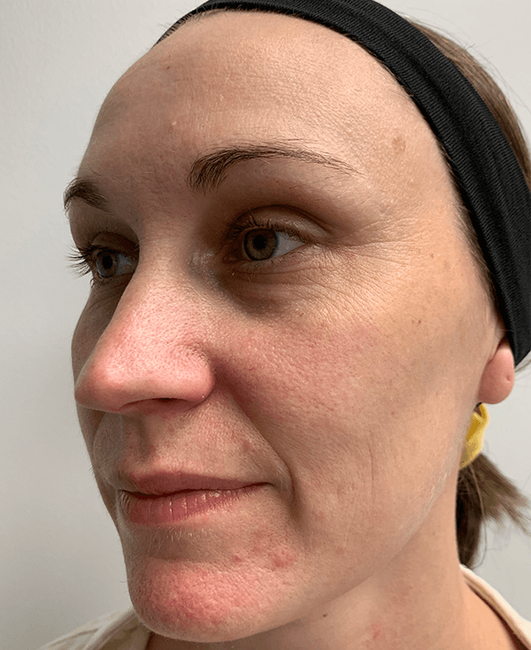 Halo Laser Before - Patient 93894513 - Front Left View