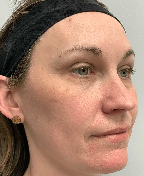 Halo Laser After - Patient 93894513 - Front Right View