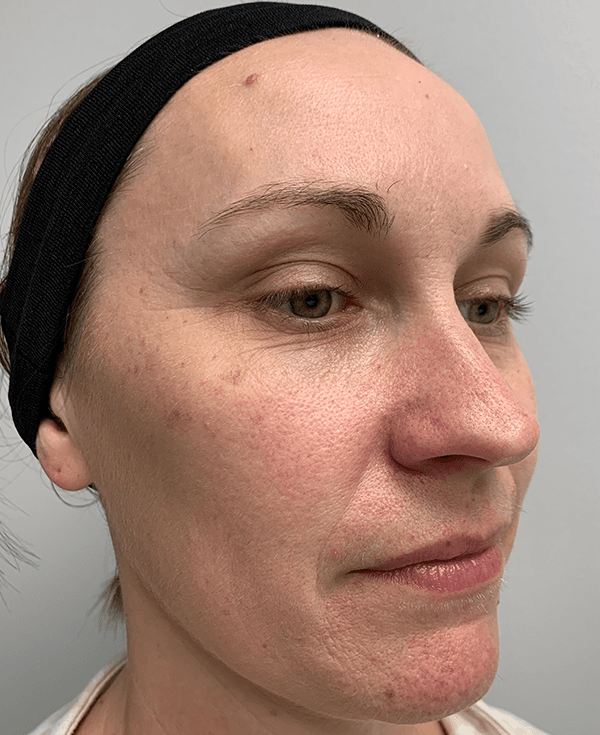 Halo Laser Before - Patient 93894513 - Front Right View