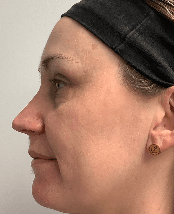 Halo Laser After - Patient 93894513 - Left View