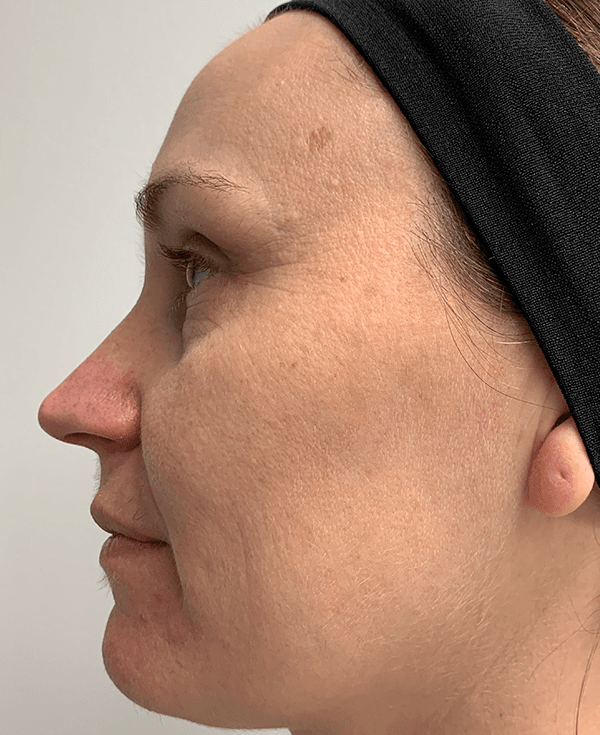 Halo Laser Before - Patient 93894513 - Left View