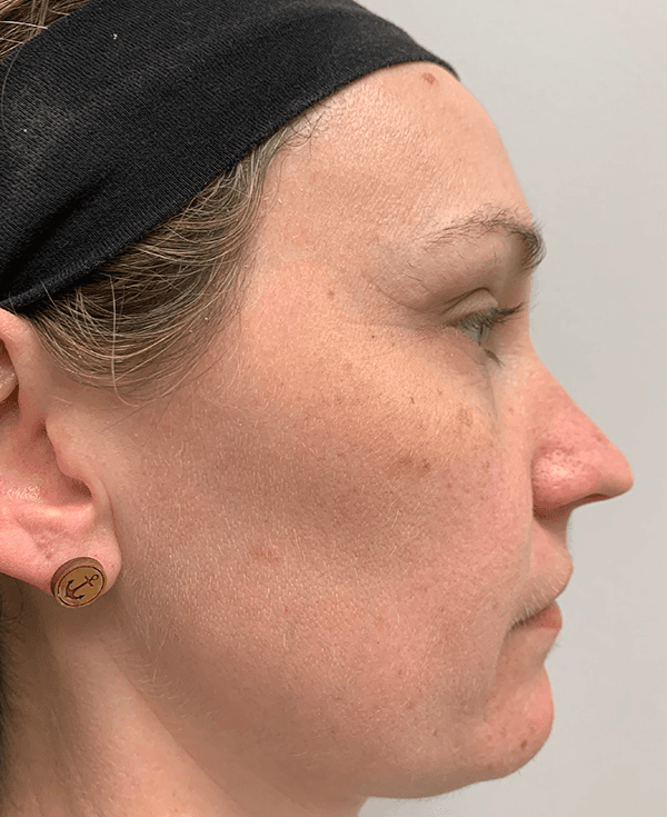 Halo Laser After - Patient 93894513 - Right View