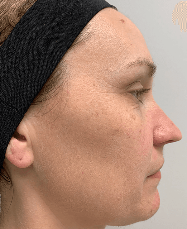 Halo Laser Before - Patient 93894513 - Right View