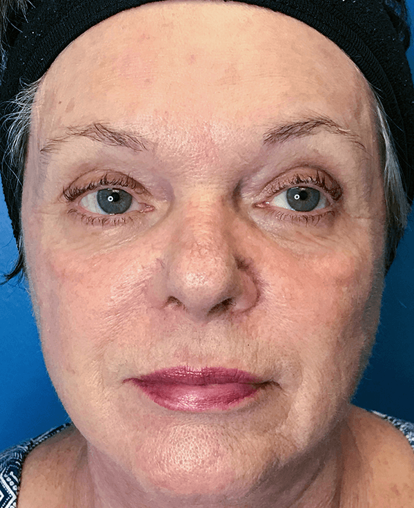 Broadband Light After - Patient 93894518 - Front View
