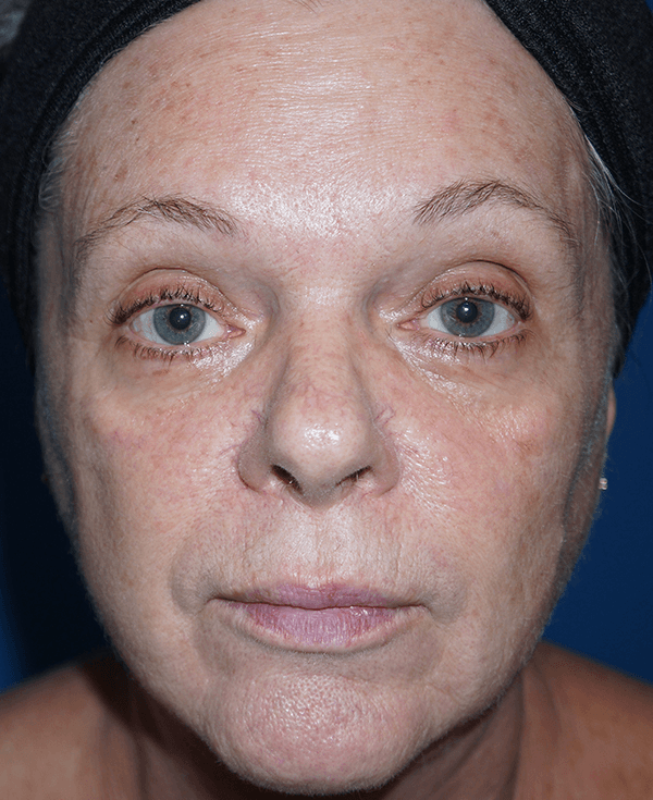 Broadband Light Before - Patient 93894518 - Front View