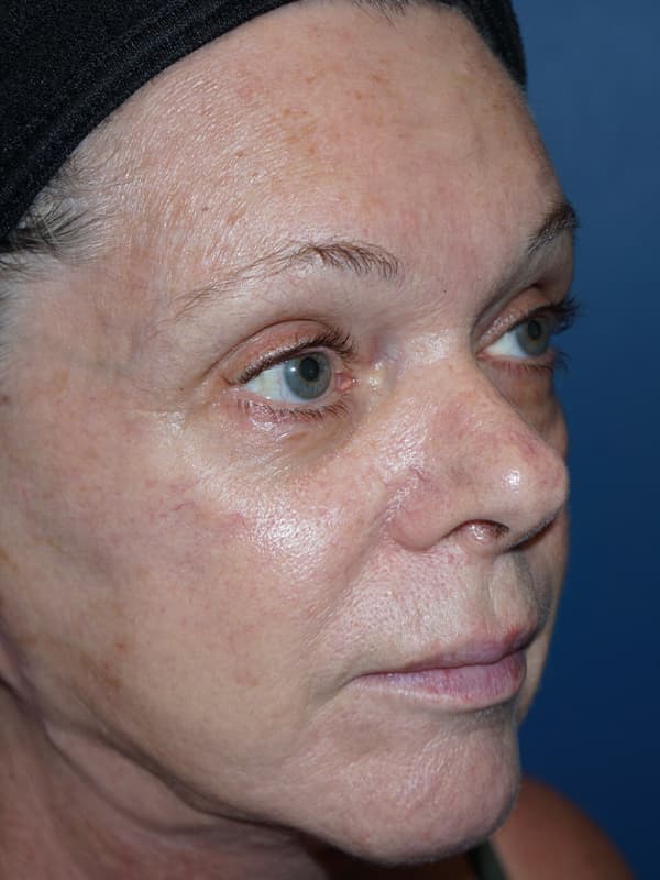 Halo Laser Before - Patient 93894518 - Front Right View