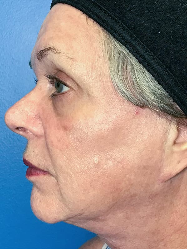 Halo Laser After - Patient 93894518 - Left View