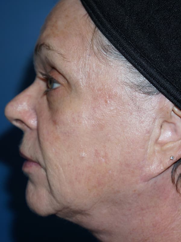 Halo Laser Before - Patient 93894518 - Left View