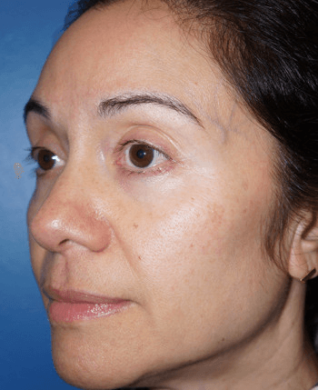 Halo Laser After - Patient 93894399 - Front Left View