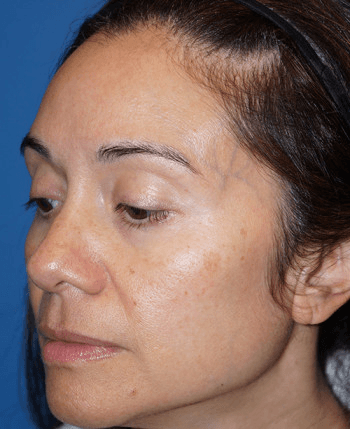 Halo Laser Before - Patient 93894399 - Front Left View