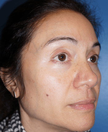 Halo Laser After - Patient 93894399 - Front Right View