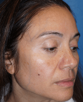 Halo Laser Before - Patient 93894399 - Front Right View