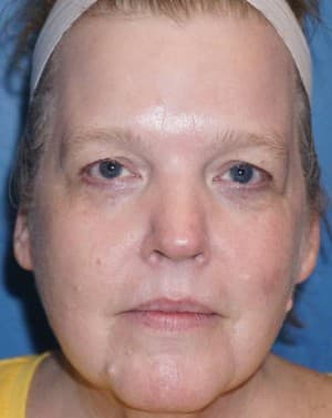 Halo Laser After - Patient 93894541 - Front View