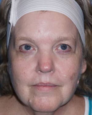 Halo Laser Before - Patient 93894541 - Front View