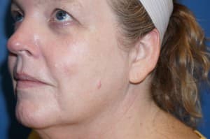 Halo Laser After - Patient 93894541 - Front Left View
