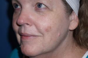 Halo Laser Before - Patient 93894541 - Front Left View