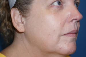 Halo Laser After - Patient 93894541 - Front Right View