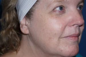 Halo Laser Before - Patient 93894541 - Front Right View