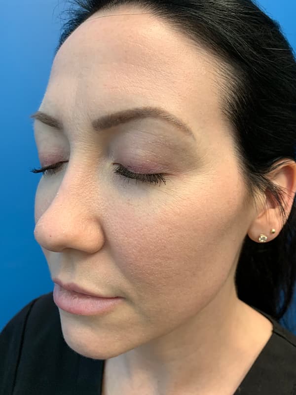 Halo Laser After - Patient 93894548