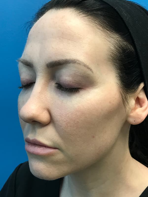 Halo Laser Before - Patient 93894548 - Front View