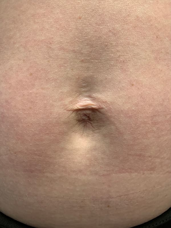 Halo Laser Before - Patient 93894557 - Front View