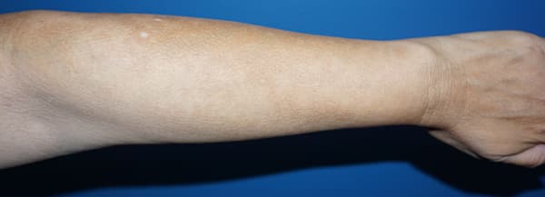 Halo Laser After - Patient 93894589 - Arm View