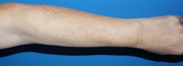 Halo Laser Before - Patient 93894589 - Arm View