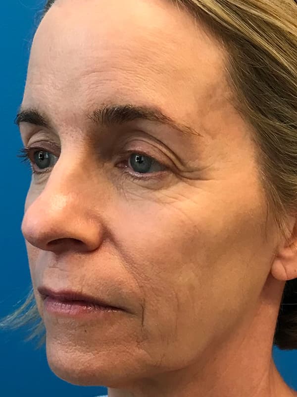 Halo Laser After - Patient 93894614 - Front Left View
