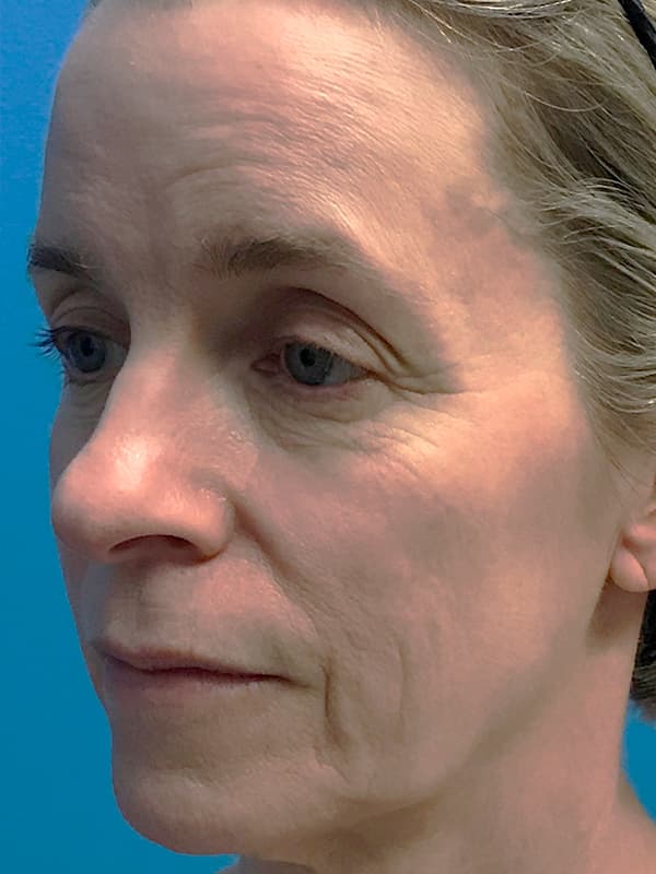 Halo Laser Before - Patient 93894614 - Front Left View