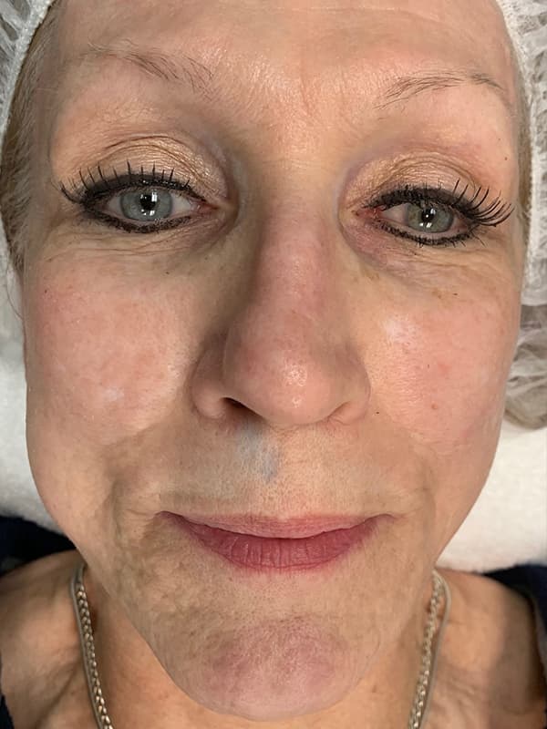 Contour TRL After - Patient 93894678 - Front View