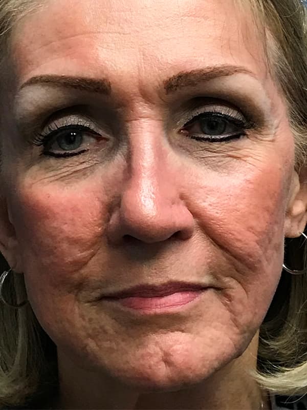 Halo Laser Before - Patient 93894678