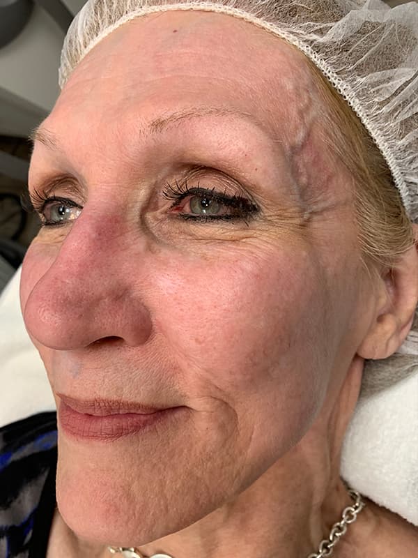 Halo Laser After - Patient 93894678 - Front Left View