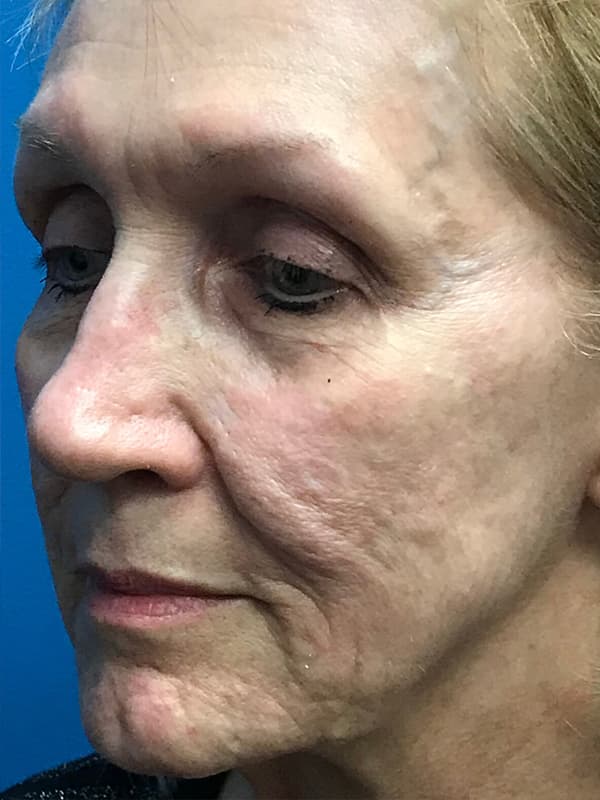Halo Laser Before - Patient 93894678 - Front Left View