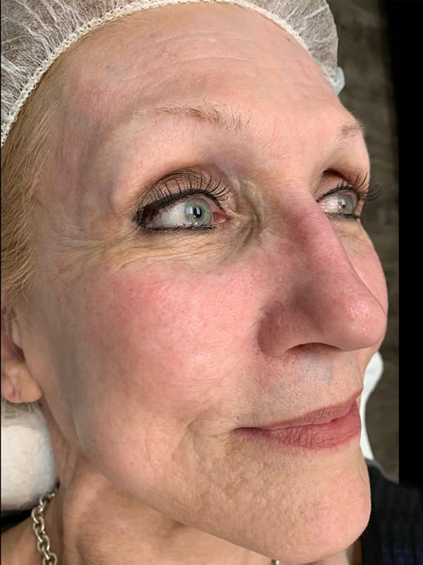 Halo Laser After - Patient 93894678 - Front Right View