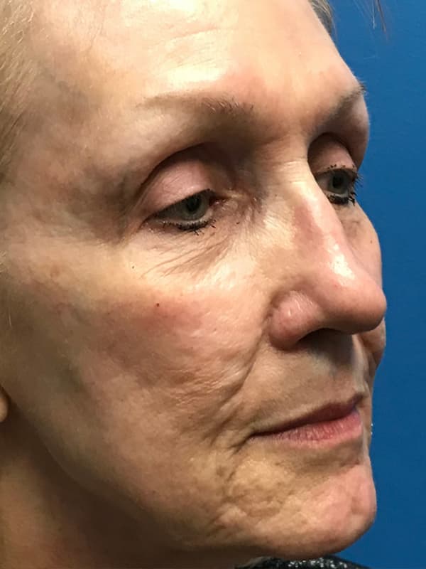 Halo Laser Before - Patient 93894678 - Front Right View