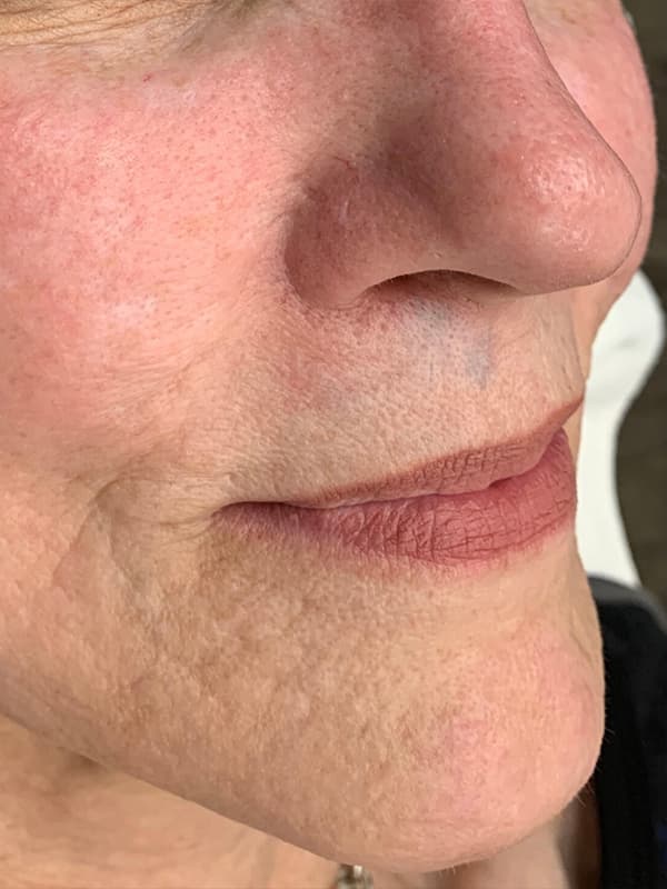 Halo Laser After - Patient 93894678 - Front Right Close View