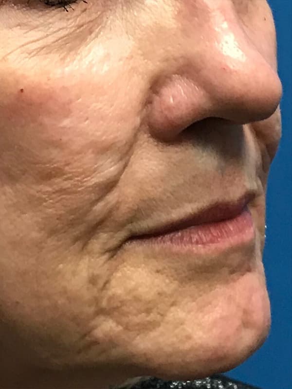 Halo Laser Before - Patient 93894678 - Front Right Close View