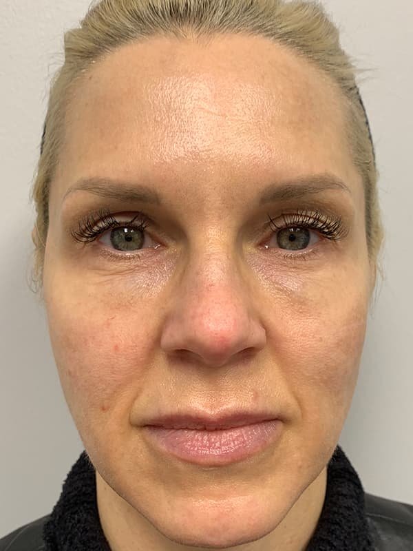 Aquagold Fine Touch After - Patient 93894762 - Front View