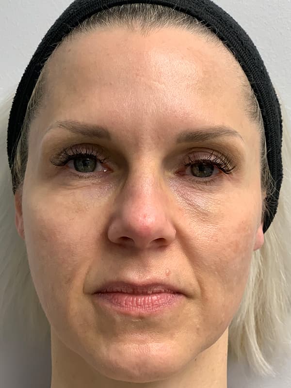 Aquagold Fine Touch Before - Patient 93894762 - Front View