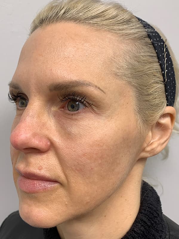 Aquagold Fine Touch After - Patient 93894762 - Front Left View