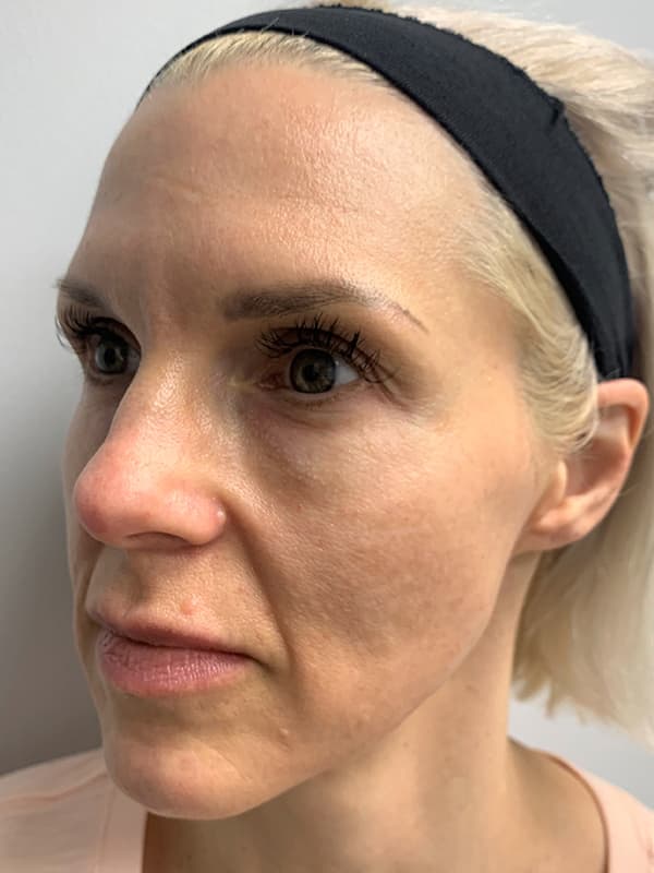 Aquagold Fine Touch Before - Patient 93894762 - Front Left View