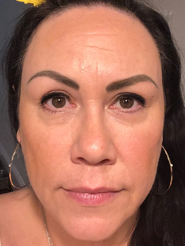 Aquagold Fine Touch After - Patient 93896652 - Front View