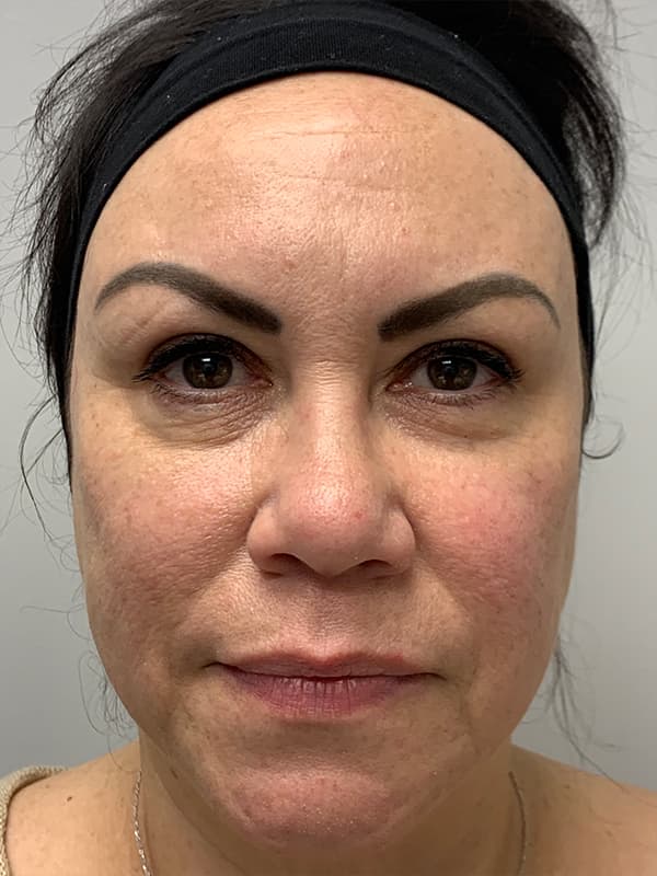 Aquagold Fine Touch Before - Patient 93896652 - Front View