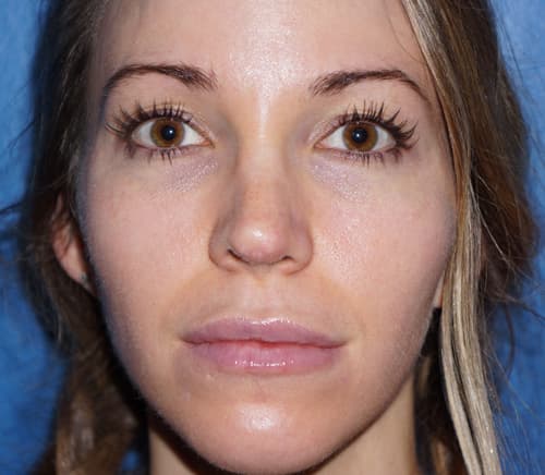 Halo Laser After - Patient 93894648 - Front View