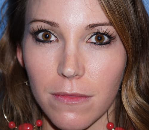 Halo Laser Before - Patient 93894648 - Front View