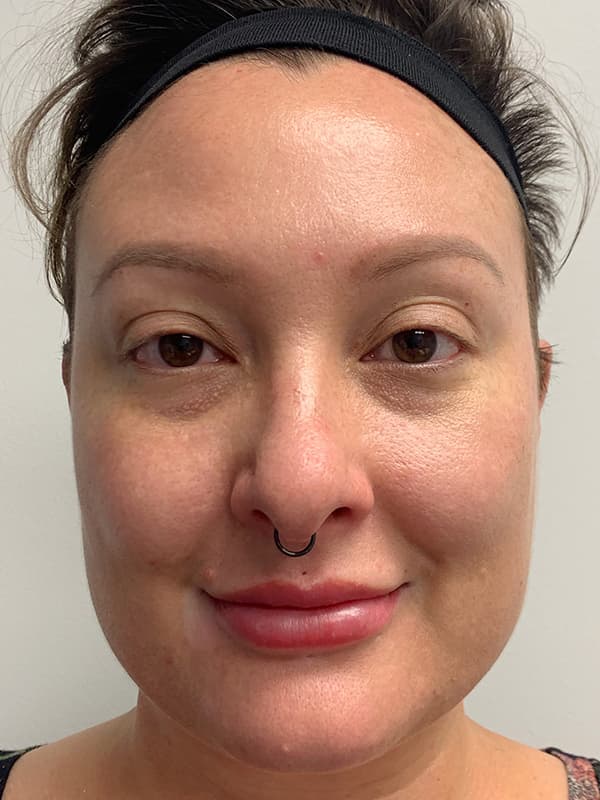 Halo Laser After - Patient 93898058 - Front View