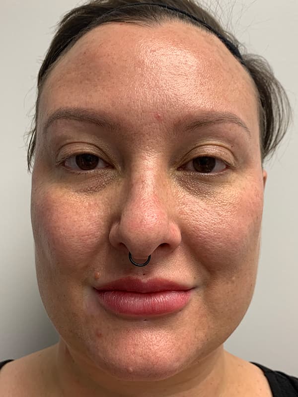 Halo Laser Before - Patient 93898058 - Front View