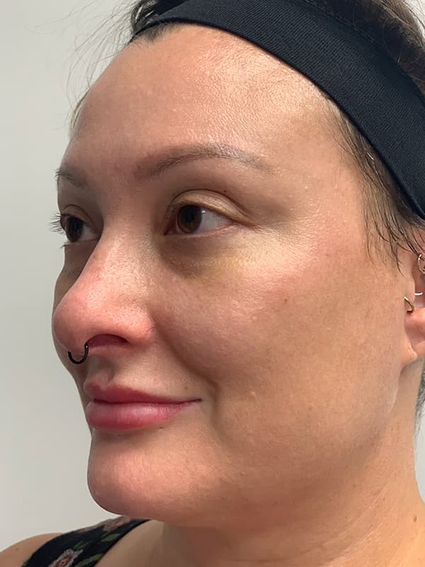 Halo Laser After - Patient 93898058 - Front Left View