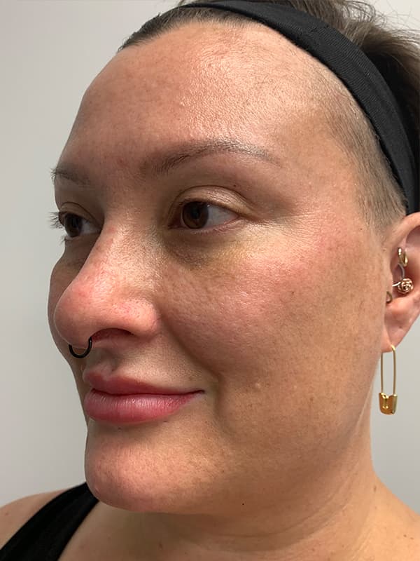 Halo Laser Before - Patient 93898058 - Front Left View